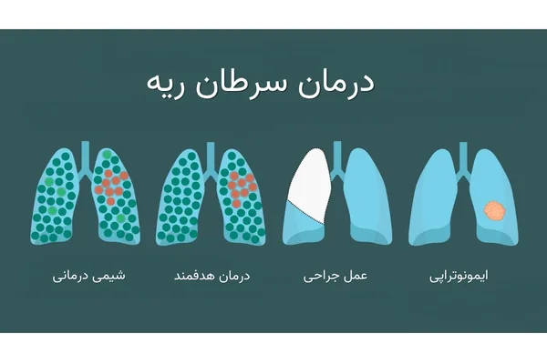 روش های درمان سرطان ریه